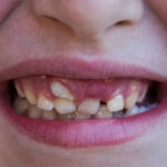 Çfarë janë “Dhëmbët e peshkaqenit” tek fëmijët?