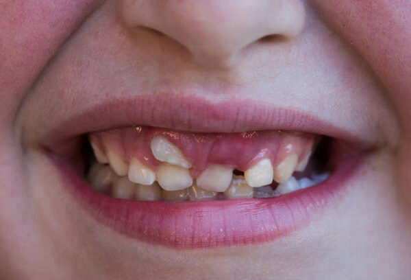 Çfarë janë “Dhëmbët e peshkaqenit” tek fëmijët?