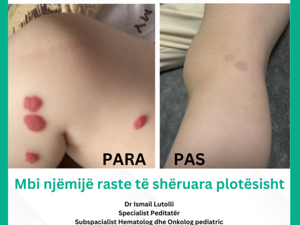 Hemangioma ka shërim të plotë